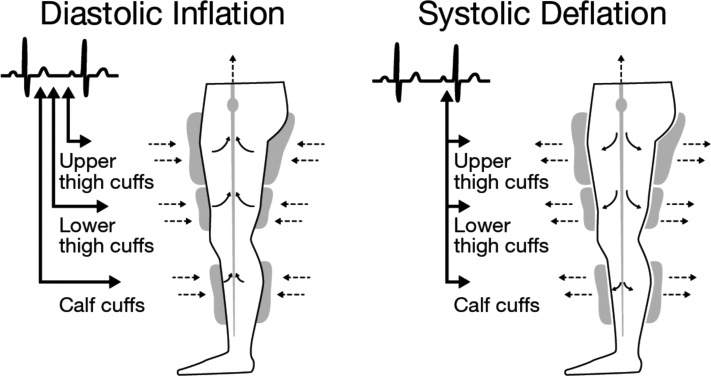 EECP Therapy Process