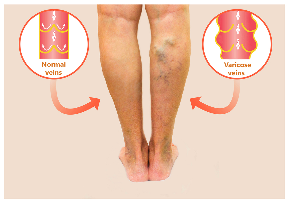 Alternative Treatment For Varicose Veins Bulging Veins In Legs Treatment