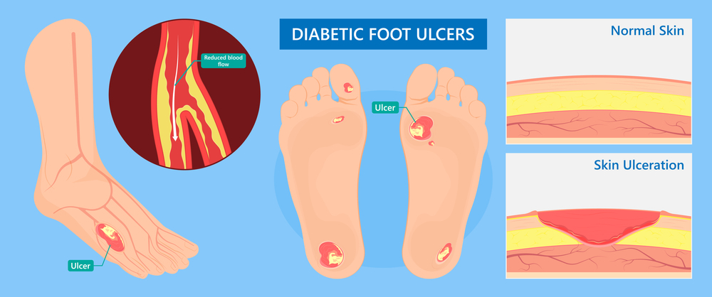 Diabetic foot ulcer Cut Out Stock Images & Pictures - Alamy